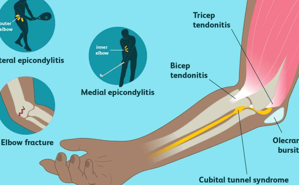 elbow pain inforgraphic