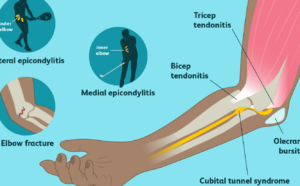 elbow pain inforgraphic
